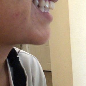 Nên chọn niềng kim loại, niềng trong suốt hay phẫu thuật để sửa khớp cắn sâu?