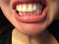 Cách điều trị khớp cắn chéo