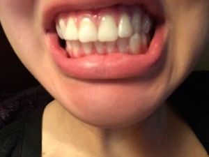 Cách điều trị khớp cắn chéo