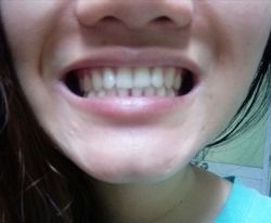 Cách làm cho răng hàm dưới khít lại