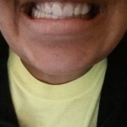 Hai hàm không thẳng hàng thì nên niềng răng hay phẫu thuật hàm?
