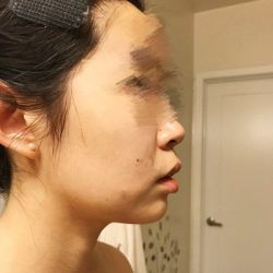 Má có bị hóp khi niềng răng không?