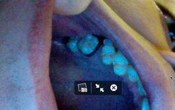 Mất răng hàm: Nên niềng răng hay lắp cầu răng sứ?