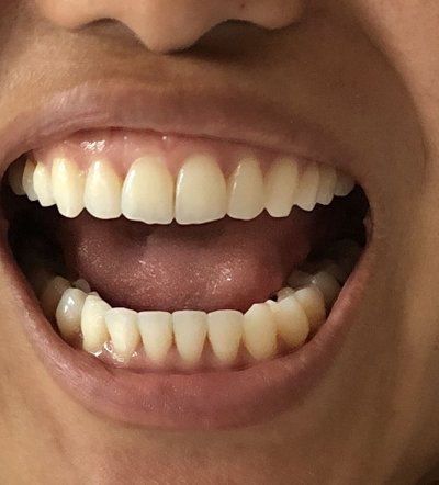 Niềng răng kim loại có sửa được đường midline bị lệch và khớp cắn sâu không?