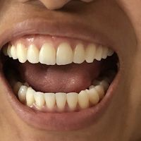 Niềng răng kim loại có sửa được đường midline bị lệch và khớp cắn sâu không?
