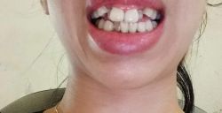 Răng bé, khấp khểnh nên chọn niềng hay bọc răng sứ?