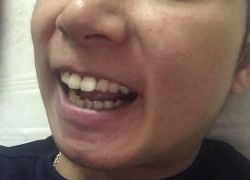 Niềng răng hay mài ốp răng sứ?