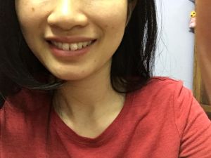 Răng cửa bị thưa, chìa ra ngoài