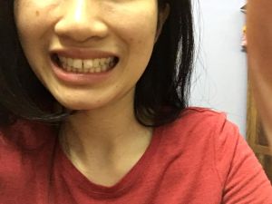 Răng cửa bị thưa, chìa ra ngoài