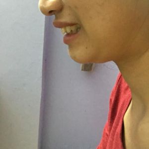 Răng cửa bị thưa, chìa ra ngoài