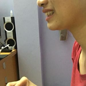 Răng cửa bị thưa, chìa ra ngoài