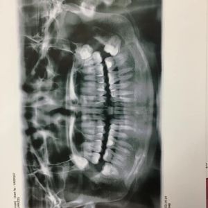 Răng cửa bị thưa, chìa ra ngoài