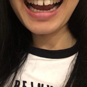 Răng cửa bị thưa, chìa ra ngoài