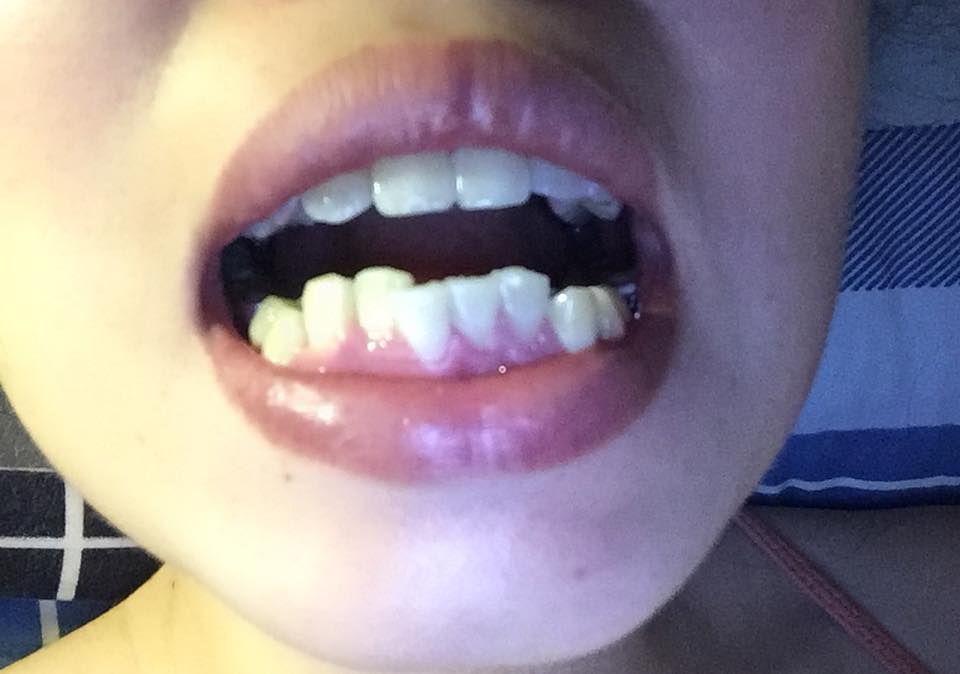 Niềng răng mặt lưỡi (mặt trong) và cách chăm sóc