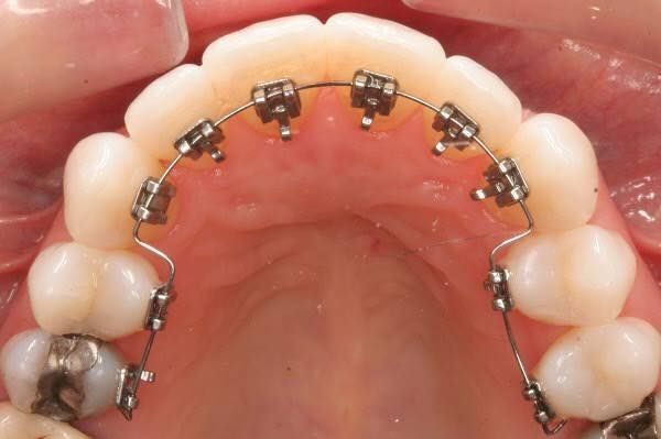 Niềng răng mặt lưỡi (mặt trong) và cách chăm sóc