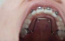 Nong hàm khi đeo niềng răng đau lâu không?