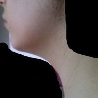 CoolSculpting và Ultherapy có thể trị vấn đề nọng cằm và cổ gà tây không?