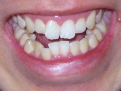 Răng khấp khểnh thì nên chọn niềng kim loại hay niềng trong suốt Invisalign?