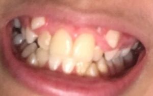 Răng nanh mọc lệch lên trên thì cần làm gì?