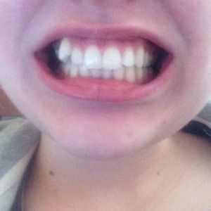 Răng nanh khểnh thì nên làm thế nào?