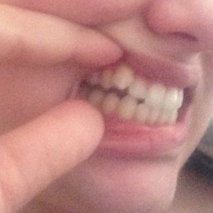 Răng nanh khểnh thì nên làm thế nào?