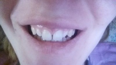 Răng nhỏ quá thì nên làm gì?