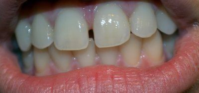 Có cần niềng răng để đóng khoảng hở nhỏ giữa răng cửa không?