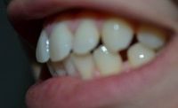 Có cần niềng răng để đóng khoảng hở nhỏ giữa răng cửa không?