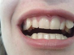 Răng nanh xoay thì nên chọn niềng thường hay niềng trong suốt?