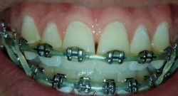 Sắp tháo niềng rồi mà răng vẫn còn thưa