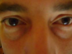 Cách tốt nhất để khắc phục rãnh nước mắt?