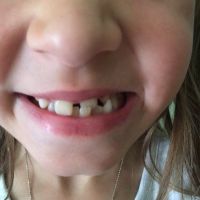 7 tuổi đã nên niềng răng hay chưa?