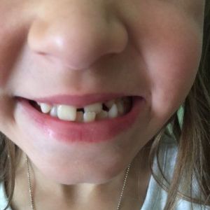 7 tuổi đã nên niềng răng hay chưa?