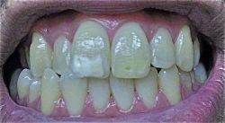 Niềng răng xong rồi dán sứ Veneer hay chỉ cần dán sứ Veneer?