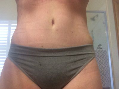 Cùng theo dõi quá trình hút bỡ hai bên hông, sườn và lưng của bà mẹ 46 tuổi