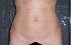 Khắc phục bụng lồi lõm sau hút mỡ