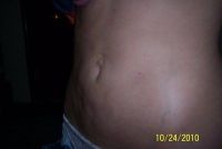 Khắc phục bụng lồi lõm sau hút mỡ