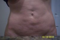 Khắc phục bụng lồi lõm sau hút mỡ