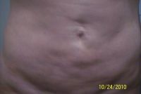 Khắc phục bụng lồi lõm sau hút mỡ