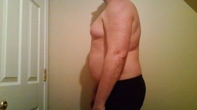 Hút mỡ cho nam giới: quý ông 40 tuổi với hành trình hút mỡ ngực, hai bên sườn, bụng, lưng