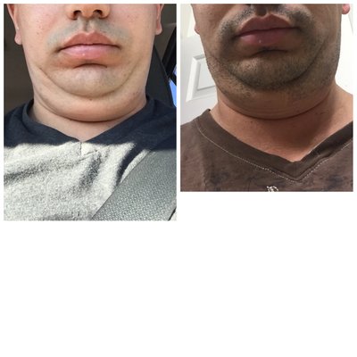 Quá trình xóa cằm đôi di truyền của quý ông 31 tuổi