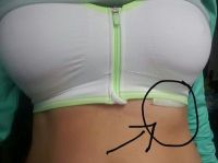 Đau xương sườn sau phẫu thuật nâng ngực 8 tuần - đây là sưng hay cục máu đông?