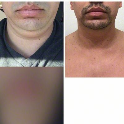 Quá trình xóa cằm đôi di truyền của quý ông 31 tuổi