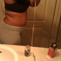 Mỗi lần hút mỡ cần cách nhau bao lâu?