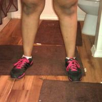 Mỗi lần hút mỡ cần cách nhau bao lâu?