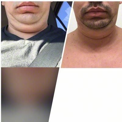 Quá trình xóa cằm đôi di truyền của quý ông 31 tuổi