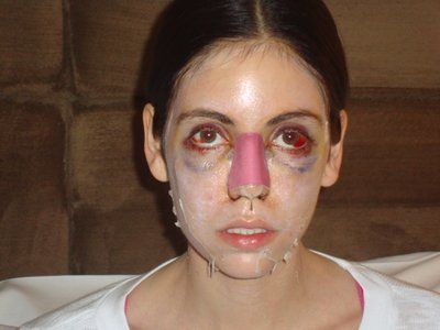 Tự tin sở hữu gương mặt baby đầy đặn với hành trình cấy mỡ tự thân vùng mặt/má và các vùng trũng sâu dưới mắt