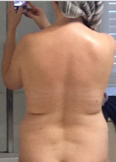 Cùng theo dõi quá trình hút bỡ hai bên hông, sườn và lưng của bà mẹ 46 tuổi