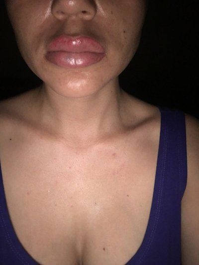 Trẻ hóa khuôn mặt với phương pháp cấy mỡ tự thân vào má, môi, nếp nhăn vùng gian mày, rãnh mũi má và chỉnh sửa mũi lõm