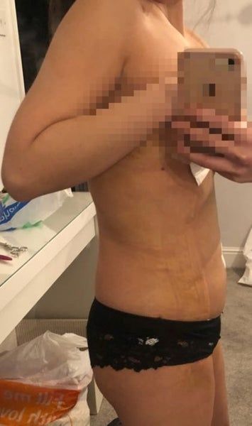 Điêu khắc tạo hình vùng bụng và ngực với kỹ thuật hút mỡ Vaser Hi Def của quý ông bị chứng vú to (Gynecomastia)